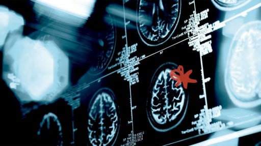 ADHD: How artificial intelligence may help in diagnosing children