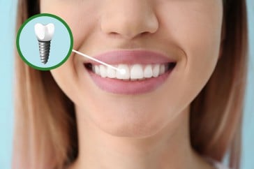 How to Choose the Right Material for Your Dental Implants